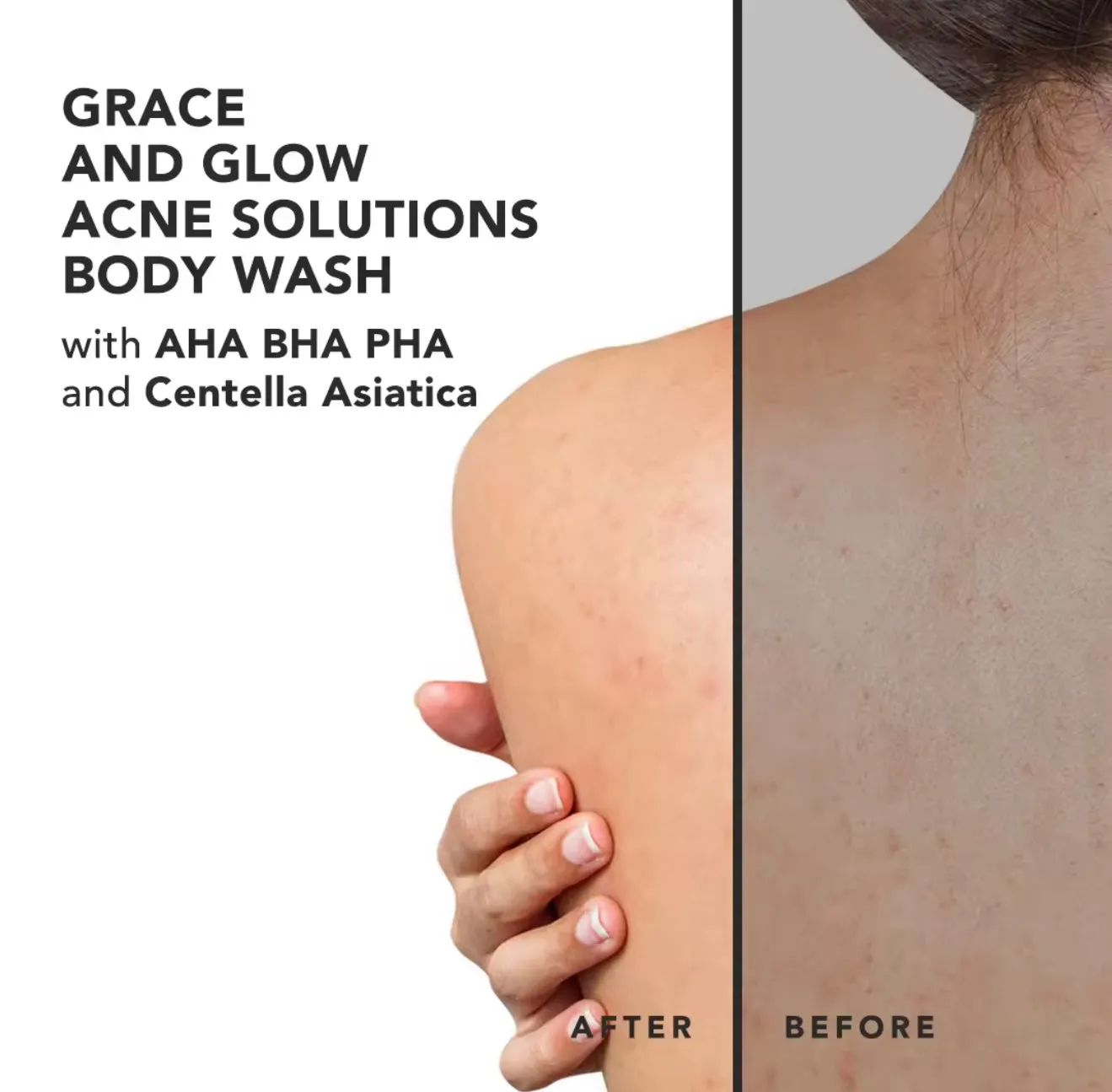 Grace and Glow - “ENGLISH PEAR AND FREESIA” Acne Solution Body Wash 400 ml